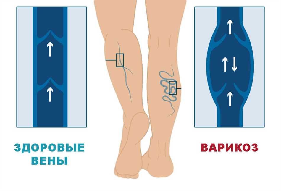 Несостоятельные перфорантные вены голени: причины, симптомы, лечение