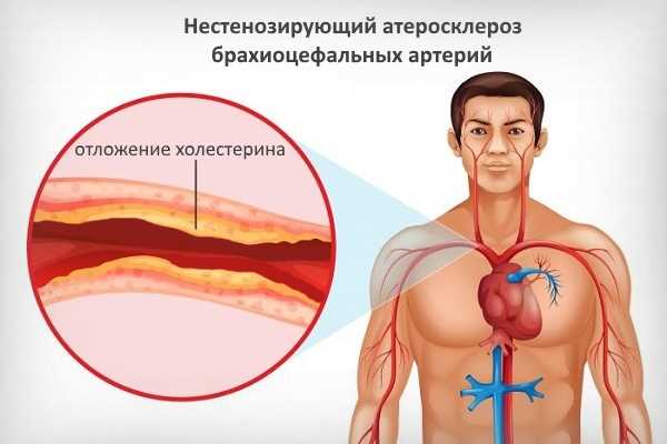 Причины нестенозирующего атеросклероза брахиоцефальных артерий