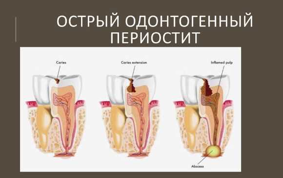 Определение одонтогенных инфекций