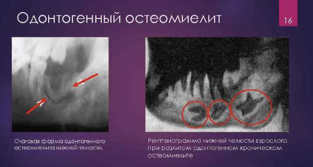 Распространенность и причины развития одонтогенных инфекций