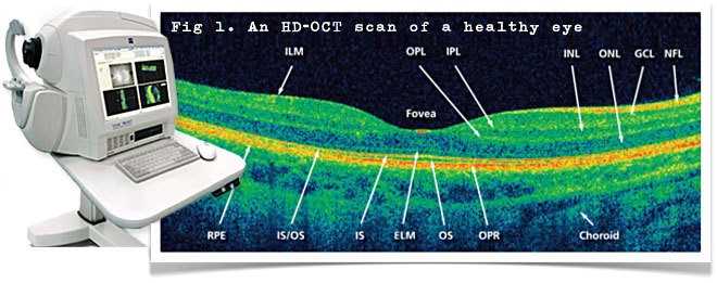 Окт глаза расшифровка: понимаем результаты исследования