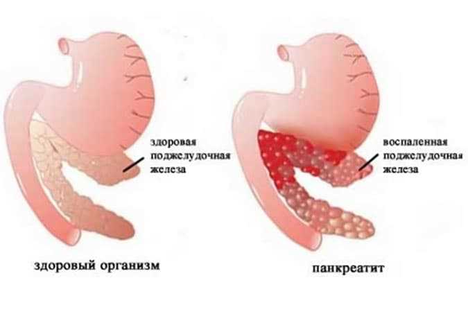 Причины опущения желудка