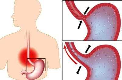 Лечение опущения желудка