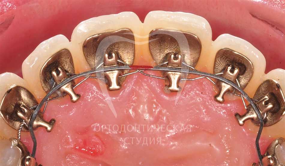 Ортодонтическое удерживающее кольцо