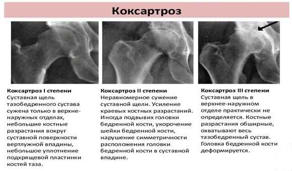 Остеоартроз тазобедренного сустава 1 степени