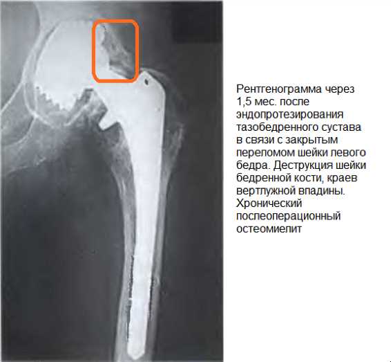 Остеомиелит тазобедренного сустава: причины, симптомы, лечение