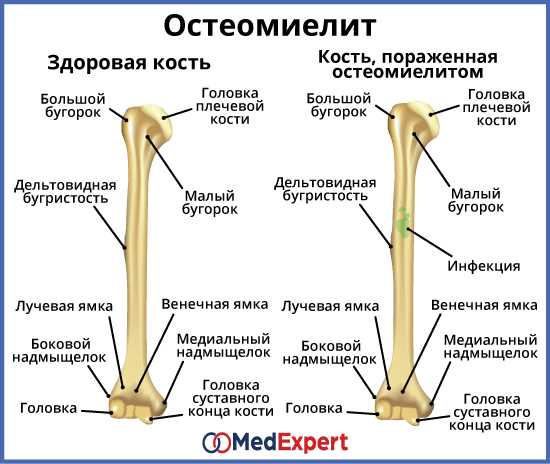 Диагностика остеомиелита тазобедренного сустава