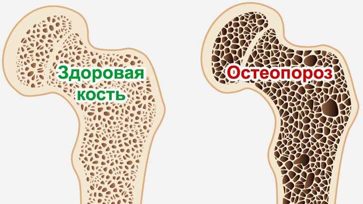 Остеопороз у женщин после 40 лет: симптомы и проявления