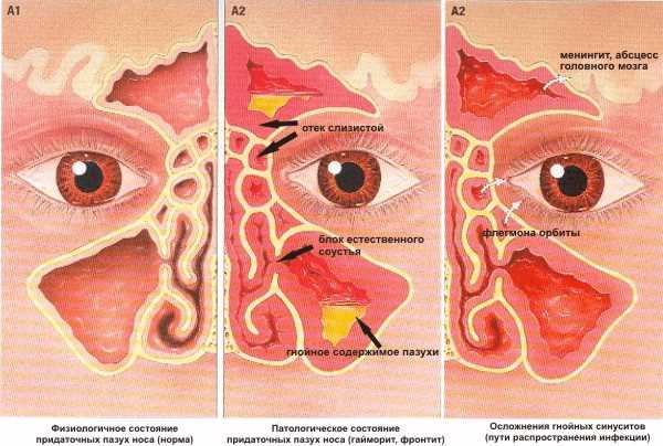 Осложнения синусита