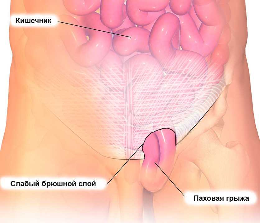 Спазм диафрагмы