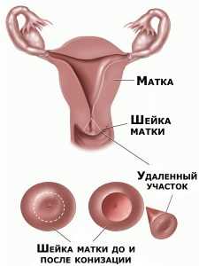 Сколько дней отходит струп после конизации шейки матки