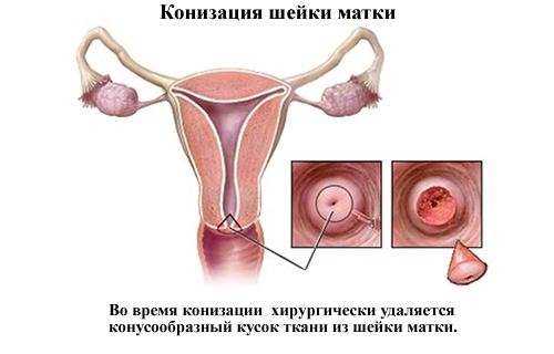 Симптомы после конизации шейки матки: